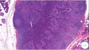 Clinical Pathology: Normal lymph node