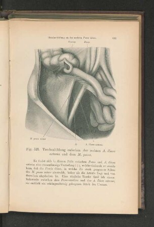 Fig. 521. Taschenbildung zwischen der rechten A. iliaca externa und dem M. psoas.