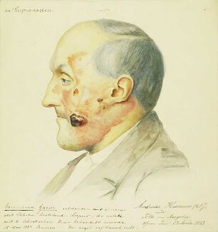 Carcinoma faciei. Krankenbildnis Andreas Hansen