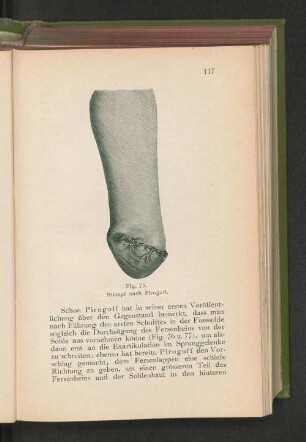 Fig. 75. Stumpf nach Pirogoff.