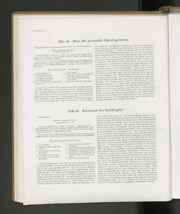 Abb. 42 Karzinom des Kehlkopfes