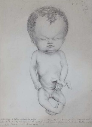 Kind mit Wasserkopf, Hydrocephalus