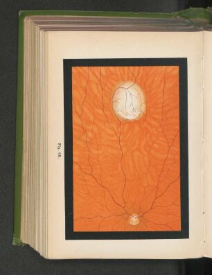 Fig. 66. Gliom der Netzhaut.