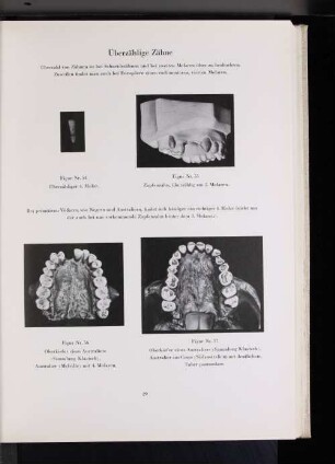 Figur Nr. 56 Oberkiefer eine Australiers (Sammlung Klaatsch). Australier (Melville) mit 4. Molaren.
