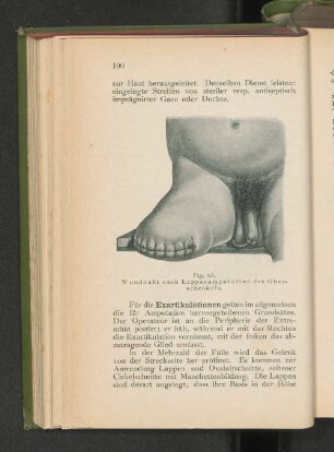 Fig. 65. Wundnaht nach Lappenamputation des Oberschenkels.