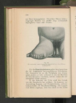 Fig. 65. Wundnaht nach Lappenamputation des Oberschenkels.