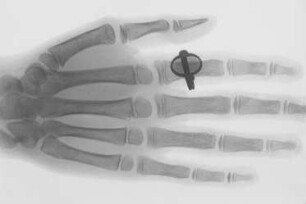 Röntgenaufnahme, Hand mit Ring : Technikgeschichte | Physik | Elektrizität | Röntgenstrahlen