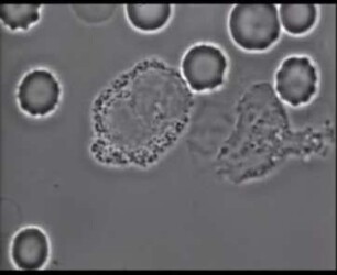 Phagozytose von Kernmaterial im Supravitalpräparat durch Monozyten "Tart-Zelle" und "Sjögren-Zelle"
