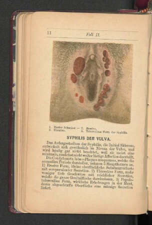 Syphilis der Vulva.