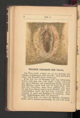 Weicher Schanker der Vulva.