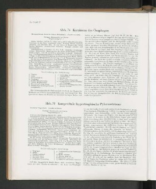 Abb. 75 Kongenitale hypertrophische Pylorusstenose