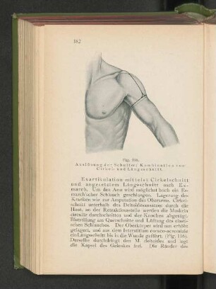 Fig. 116. Auslösung der Schulter; Kombination von Cirkel- und Längsschnitt.