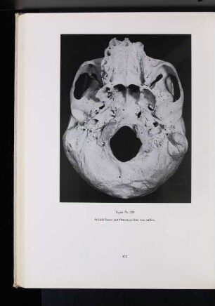 Figur Nr. 280 Schädelbasis mit Osteomyelitis von außen.