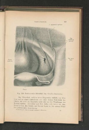 Fig. 529. Peritonaeales Divertikel des Canalis obturatorius.