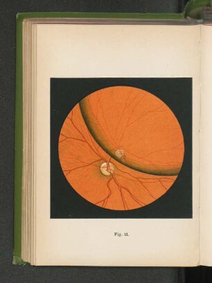 Fig. 11. Angeborene Verschiebung der Linse - Ektopia lentis congenita - nach unten-aussen, am rechten Auge.