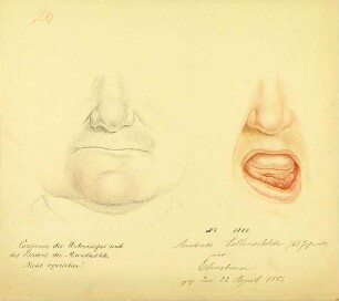 Carcinom des Unterkiefers und des Bodens der Mundhöhle. Krankenbildnis Andreas Sellenschloh