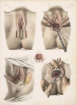 Die Vernähung und Behandlung vaginaler Fisteln