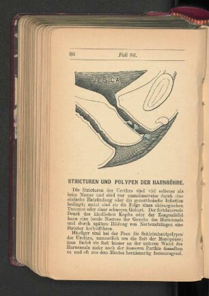 Stricturen und Polypen der Harnröhre.
