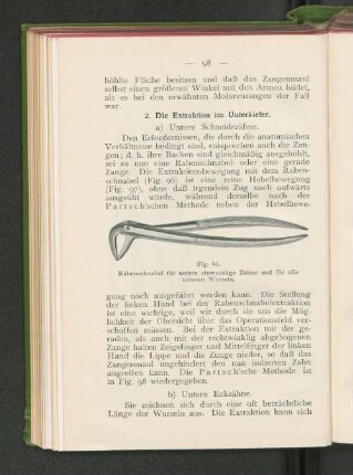 2. Die Extraktion im Unterkiefer.