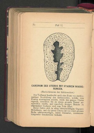 Carcinom des Uterus mit starken Wucherungen.