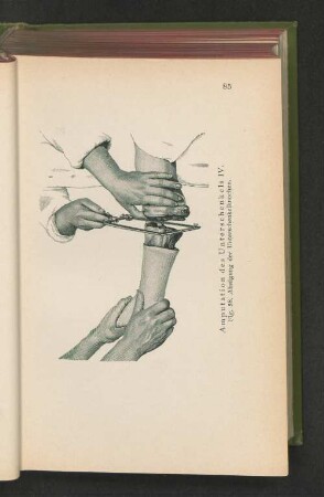 Fig. 58. Amputation des Unterschenkels IV. Absägung der Unterschenkelknochen.