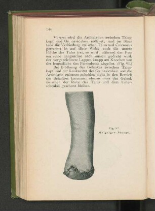 Fig. 92. Malgaigne.Stumpf.