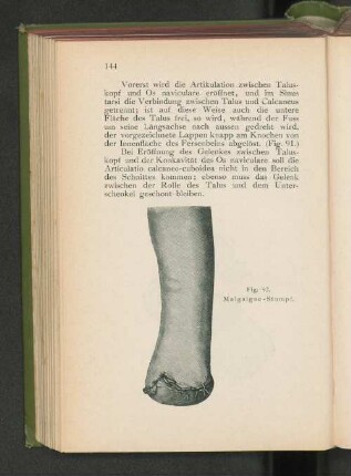 Fig. 92. Malgaigne.Stumpf.