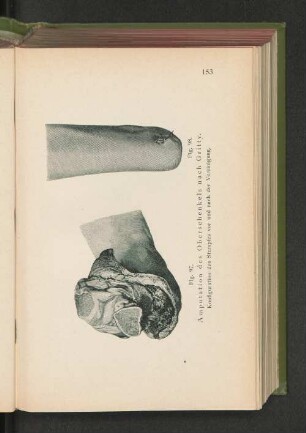 Fig. 97. Amputation des Oberschenkels nach Gritty.