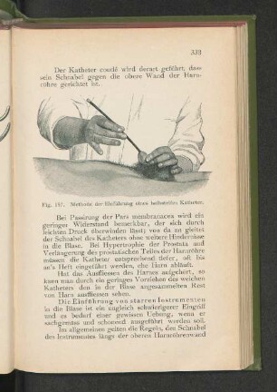 Fig. 197. Methode der Einführung eines halbsteifen Katheter.