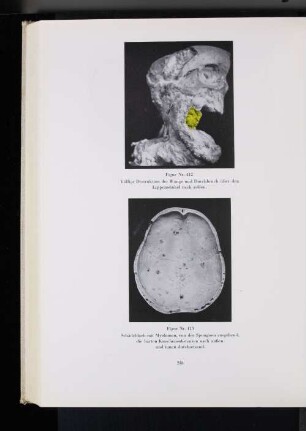 Figur Nr. 413 Schädeldach mit Myelomen, von der Sppngiosa ausgehend, die harte Knochensubstanz nach außen und innen durchsetzt.