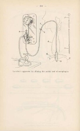 Lerche's apparatus for dilating the cardinal end of oesophagus