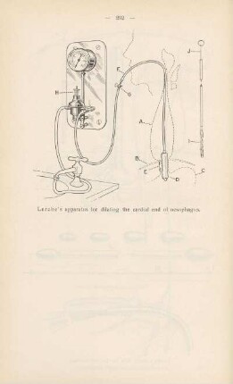 Lerche's apparatus for dilating the cardinal end of oesophagus