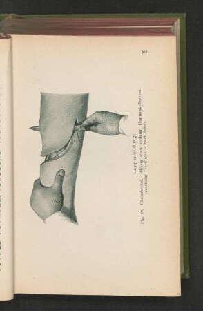 Fig. 59. Lappenbildung. Oberschenkel. Bildung eines vorderen Hautmuskellappens vermittelst Transfixion in zwei Zeiten.