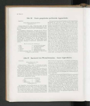 Abb. 85 Karzinoid des Wurmfortsatzes. Akute Appendizitis