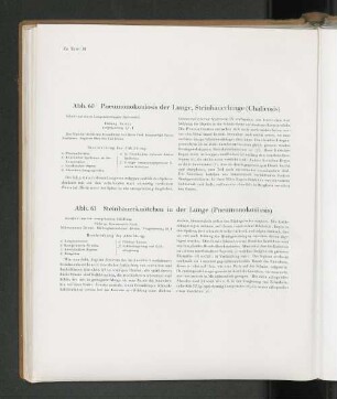 Abb. 60 Pneumonokoniosis der Lunge, Steinhauerlunge (Chalicosis)