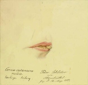 Cornu cutaneum recidiv. Krankenbildnis Peter Schlüter