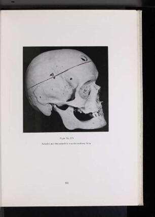 Figur Nr. 279 Schädel mit Ostemyelitis von der rechten Seite.