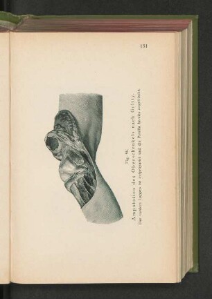 Fig. 96. Amputation des Oberschenkels nach Gritty.