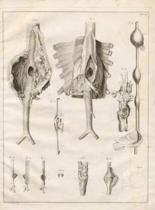 Verschiedene Aneurysmen an der Aorta thoracica