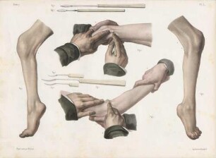 Instrumente für Tenotomie, entwickelt von M. J. Guèrin