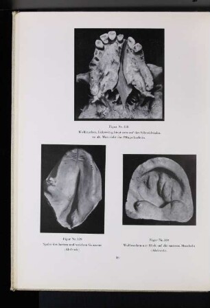 Figur Nr. 129 Spalte des harten und weichen Gaumens (Abdruck).