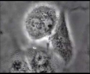 Portio-Carcinom in vitro - Stamm HeLa - Homo sapiens - Cytomorphologie