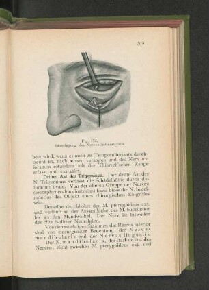 Dritter Ast des Trigeminus.