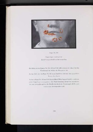 Figur Nr. 344 Impetigo contagiosa durch Streptokokken hervorgerufen.
