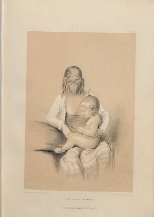 The hairy woman