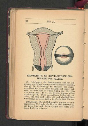 Endometritis mit doppelseitiger Zerreissung des Halses.