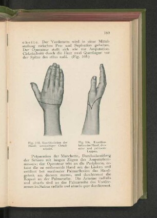 Fig. 106: Exartikulation der Hand: dorsaler und palmarer Lappen.