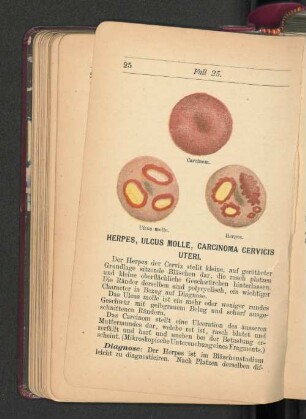 Herpes, Ulcus Molle, Carcinoma Cervicis Uteri.