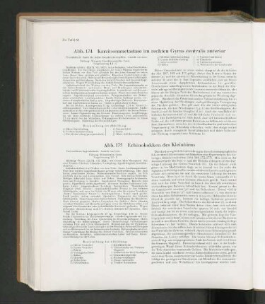 Abb. 174 Karzinommetastase im rechten Gyrus centralis anterior