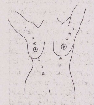 Zeichnung einer schematischen Zeichnung von einem weiblichen Torso mit mehreren Brustwarzen